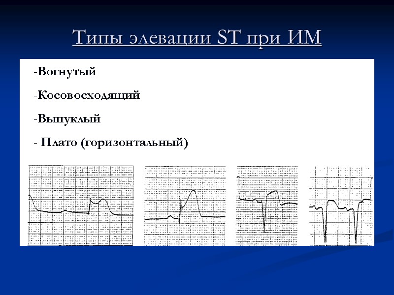 Типы элевации ST при ИМ Вогнутый Косовосходящий Выпуклый  Плато (горизонтальный)
